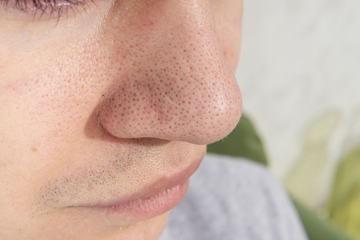 3 Tips Mengatasi Closed Comedones agar Kulit Hidung Lebih Mulus