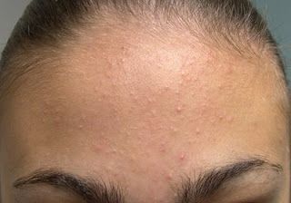 6 Cara Ampuh Hilangkan bruntusan di jidat - MedikacareSkincare
