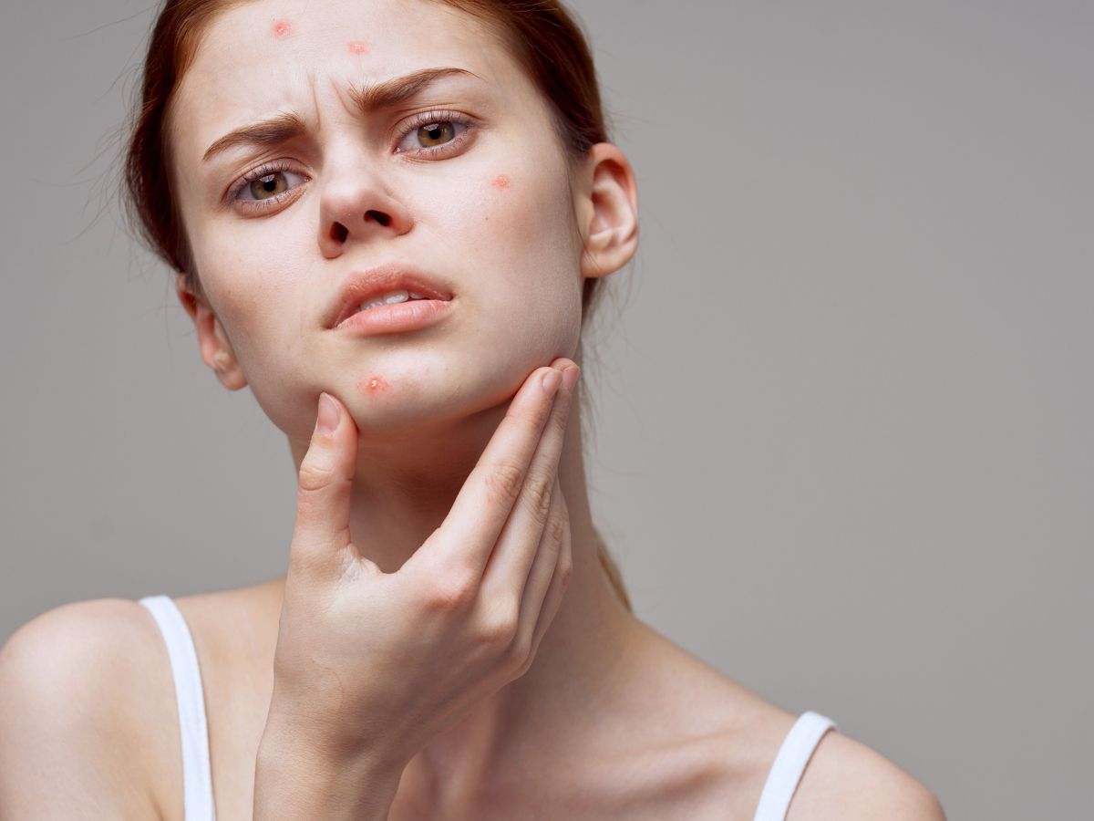 Jerawat Purging vs Breakout - MediakcareSkincare