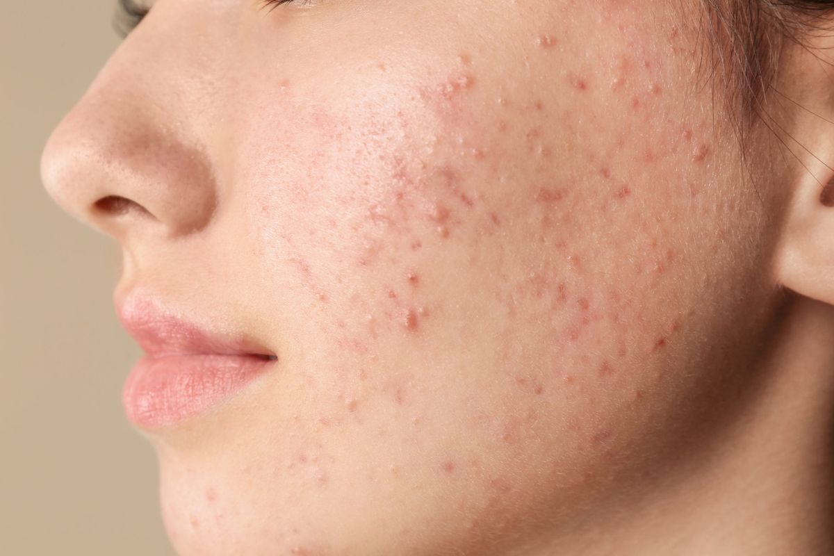 Cara Menghilangkan Noda Bekas Jerawat - MedikacareSkincare